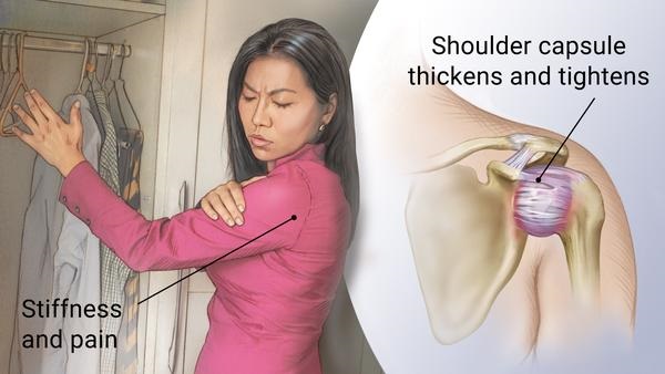 frozen shoulder cure one minute