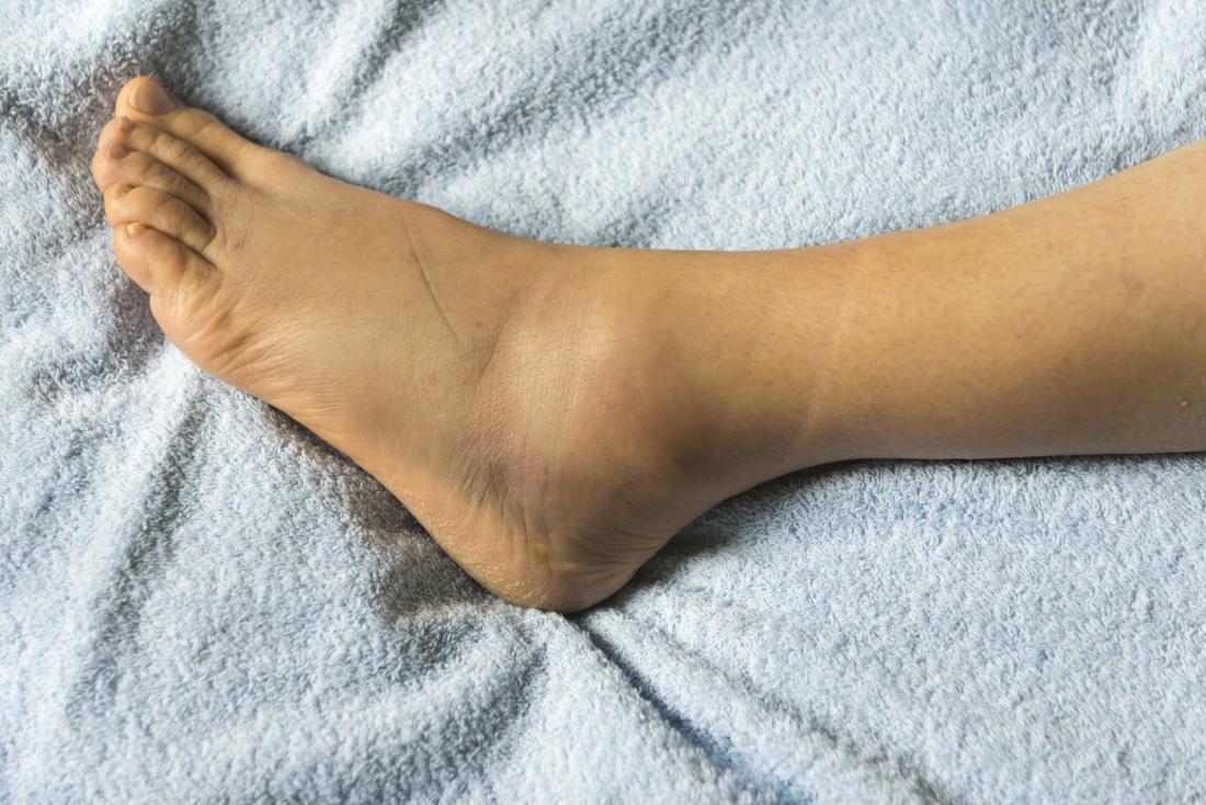 Feet And Ankle Swelling Causes At Charles Wong Blog